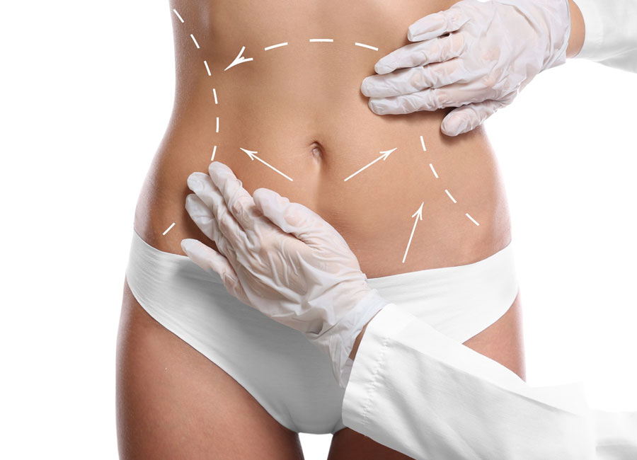 Bauchdeckenstraffung